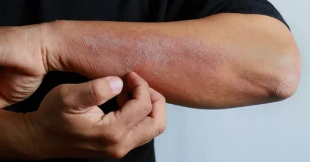 What is Psoriasis?